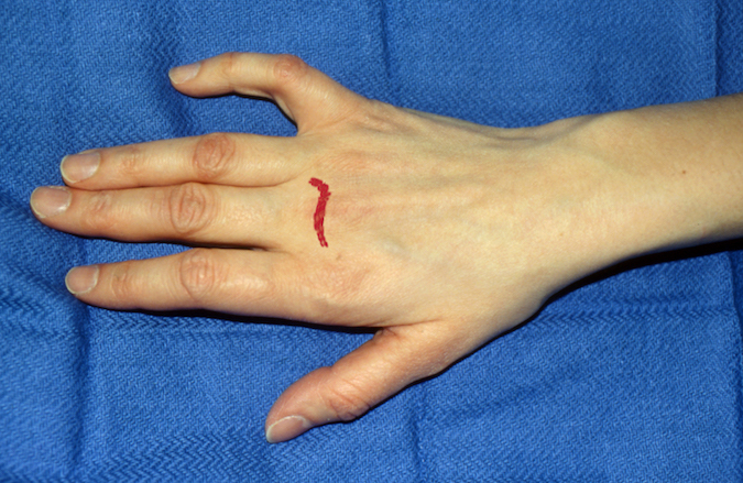 LACERATION (OPEN WOUND) | Hand Surgery Resource